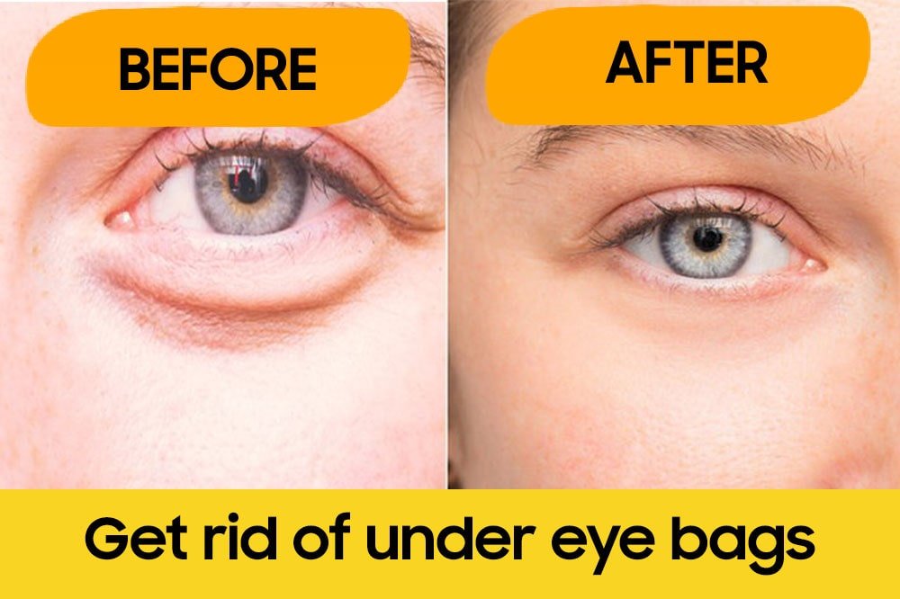 How to Get Rid of Under Eye Bags: What To Use For Under Eye Bags? 