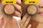 Apple Cider Vinegar On Acne