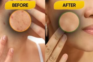 Apple Cider Vinegar On Acne Apple Cider Vinegar On Acne