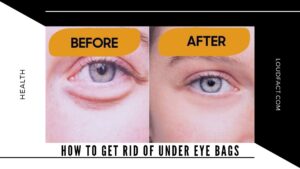 How to Get Rid of Under Eye Bags How to Get Rid of Under Eye Bags