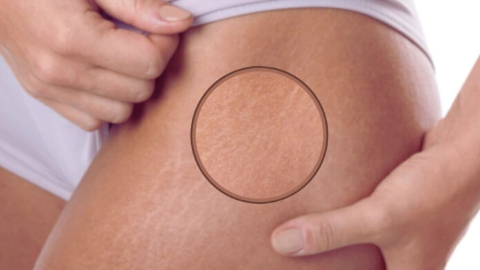 Stretch Marks On Inner Thighs Stretch Marks On Inner Thighs