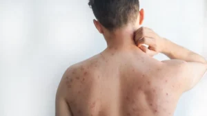 Measles