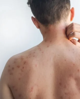 Measles